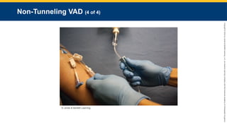 Copyright
©
2023
by
Jones
&
Bartlett
Learning,
LLC,
an
Ascend
Learning
Company
and
the
American
Academy
of
Orthopaedic
Surgeons.
Non-Tunneling VAD (4 of 4)
© Jones & Bartlett Learning.
 