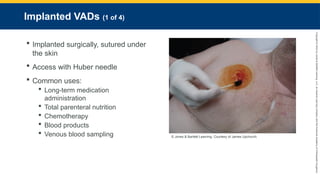 Copyright
©
2023
by
Jones
&
Bartlett
Learning,
LLC,
an
Ascend
Learning
Company
and
the
American
Academy
of
Orthopaedic
Surgeons.
Implanted VADs (1 of 4)
 Implanted surgically, sutured under
the skin
 Access with Huber needle
 Common uses:
 Long-term medication
administration
 Total parenteral nutrition
 Chemotherapy
 Blood products
 Venous blood sampling © Jones & Bartlett Learning. Courtesy of James Upchurch.
 