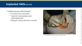 Copyright
©
2023
by
Jones
&
Bartlett
Learning,
LLC,
an
Ascend
Learning
Company
and
the
American
Academy
of
Orthopaedic
Surgeons.
Implanted VADs (2 of 4)
 Arteriovenous (AV) fistulas
 Connect vein and artery
 Used for hemodialysis and
plasmapheresis
 Require unique skill set to access
© Jones & Bartlett Learning. Courtesy of James Upchurch.
 