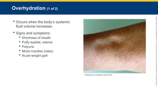 Copyright
©
2023
by
Jones
&
Bartlett
Learning,
LLC,
an
Ascend
Learning
Company
and
the
American
Academy
of
Orthopaedic
Surgeons.
Overhydration (1 of 2)
 Occurs when the body’s systemic
fluid volume increases.
 Signs and symptoms:
 Shortness of breath
 Puffy eyelids, edema
 Polyuria
 Moist crackles (rales)
 Acute weight gain
© Medical-on-Line/Alamy Stock Photo.
 
