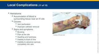 Copyright
©
2023
by
Jones
&
Bartlett
Learning,
LLC,
an
Ascend
Learning
Company
and
the
American
Academy
of
Orthopaedic
Surgeons.
Local Complications (11 of 15)
 Hematoma
 Accumulation of blood is
surrounding tissue near an IV site
 Causes:
 Vein perforation
 Improper catheter removal
 Signs and symptoms:
 Bruising
 Pain at the site
 Swelling and hardness
 Inability to flush IV line
 Inability to advance cannula
completely into vein
Courtesy of Rhonda Hunt.
 