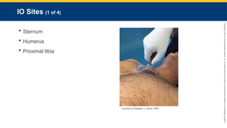 Copyright
©
2023
by
Jones
&
Bartlett
Learning,
LLC,
an
Ascend
Learning
Company
and
the
American
Academy
of
Orthopaedic
Surgeons.
IO Sites (1 of 4)
 Sternum
 Humerus
 Proximal tibia
Courtesy of Stephen J. Rahm, NRP.
 