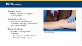 Copyright
©
2023
by
Jones
&
Bartlett
Learning,
LLC,
an
Ascend
Learning
Company
and
the
American
Academy
of
Orthopaedic
Surgeons.
IO Sites (3 of 4)
 Humeral IO site
 Manipulate arm and palpate
humeral head.
 Proximal tibia IO site
 Flat bone is medial to tibial
tuberosity, the bony protuberance
just below the knee.
 Distal tibia IO site
 Palpate to identify medial
malleolus.
 Adults: 2 to 3 cm above that site
 Pediatric: 1 to 2 cm above
© Jones & Bartlett Learning.
 