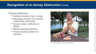 Copyright
©
2023
by
Jones
&
Bartlett
Learning,
LLC,
an
Ascend
Learning
Company
and
the
American
Academy
of
Orthopaedic
Surgeons.
Recognition of an Airway Obstruction (2 of 2)
 Severe obstruction
 Inability to breathe, talk, or cough
 May grasp at throat, turn cyanotic,
make frantic movements
 Cough is weak, ineffective, or
absent.
 Marked respiratory distress
 Weak inspiratory stridor and
cyanosis
© Jones & Bartlett Learning. Courtesy of MIEMSS
 
