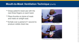 Copyright
©
2023
by
Jones
&
Bartlett
Learning,
LLC,
an
Ascend
Learning
Company
and
the
American
Academy
of
Orthopaedic
Surgeons.
Mouth-to-Mask Ventilation Technique (2 of 3)
 Grasp patient’s lower jaw with the
next three fingers on each hand.
 Place thumbs on dome of mask
and make an airtight seal.
 Exhale over a period of 1 second to
produce visible chest rise. © Jones & Bartlett Learning. Courtesy of MIEMSS.
© Jones & Bartlett Learning. Courtesy of MIEMSS.
 