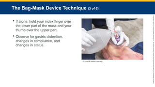 Copyright
©
2023
by
Jones
&
Bartlett
Learning,
LLC,
an
Ascend
Learning
Company
and
the
American
Academy
of
Orthopaedic
Surgeons.
The Bag-Mask Device Technique (3 of 6)
 If alone, hold your index finger over
the lower part of the mask and your
thumb over the upper part.
 Observe for gastric distention,
changes in compliance, and
changes in status.
© Jones & Bartlett Learning.
 