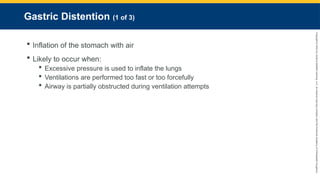 Copyright
©
2023
by
Jones
&
Bartlett
Learning,
LLC,
an
Ascend
Learning
Company
and
the
American
Academy
of
Orthopaedic
Surgeons.
Gastric Distention (1 of 3)
 Inflation of the stomach with air
 Likely to occur when:
 Excessive pressure is used to inflate the lungs
 Ventilations are performed too fast or too forcefully
 Airway is partially obstructed during ventilation attempts
 