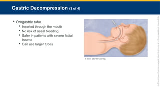 Copyright
©
2023
by
Jones
&
Bartlett
Learning,
LLC,
an
Ascend
Learning
Company
and
the
American
Academy
of
Orthopaedic
Surgeons.
Gastric Decompression (3 of 4)
 Orogastric tube
 Inserted through the mouth
 No risk of nasal bleeding
 Safer in patients with severe facial
trauma
 Can use larger tubes
© Jones & Bartlett Learning.
 