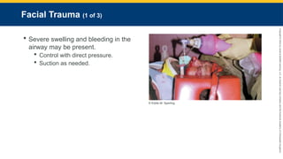 Copyright
©
2023
by
Jones
&
Bartlett
Learning,
LLC,
an
Ascend
Learning
Company
and
the
American
Academy
of
Orthopaedic
Surgeons.
Facial Trauma (1 of 3)
 Severe swelling and bleeding in the
airway may be present.
 Control with direct pressure.
 Suction as needed.
© Eddie M. Sperling.
 