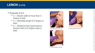 Copyright
©
2023
by
Jones
&
Bartlett
Learning,
LLC,
an
Ascend
Learning
Company
and
the
American
Academy
of
Orthopaedic
Surgeons.
LEMON (2 of 6)
 Evaluate 3-3-2.
 3 — Mouth width of more than 3
fingers is best.
 3 — Mandible length of 3 fingers is
best.
 2 — Distance from hyoid bone to
thyroid notch of 2 fingers wide is
best.
© Jones & Bartlett Learning. © Jones & Bartlett Learning.
© Jones & Bartlett Learning.
 