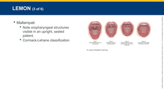 Copyright
©
2023
by
Jones
&
Bartlett
Learning,
LLC,
an
Ascend
Learning
Company
and
the
American
Academy
of
Orthopaedic
Surgeons.
LEMON (3 of 6)
 Mallampati
 Note oropharyngeal structures
visible in an upright, seated
patient.
 Cormack-Lehane classification
© Jones & Bartlett Learning.
 
