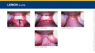 Copyright
©
2023
by
Jones
&
Bartlett
Learning,
LLC,
an
Ascend
Learning
Company
and
the
American
Academy
of
Orthopaedic
Surgeons.
LEMON (4 of 6)
Courtesy of Stephen Rahm. Courtesy of Stephen Rahm. Courtesy of Stephen Rahm.
Courtesy of Stephen Rahm.
 