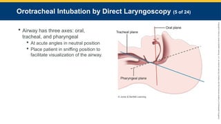 Copyright
©
2023
by
Jones
&
Bartlett
Learning,
LLC,
an
Ascend
Learning
Company
and
the
American
Academy
of
Orthopaedic
Surgeons.
Orotracheal Intubation by Direct Laryngoscopy (5 of 24)
 Airway has three axes: oral,
tracheal, and pharyngeal
 At acute angles in neutral position
 Place patient in sniffing position to
facilitate visualization of the airway.
© Jones & Bartlett Learning.
 