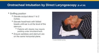 Copyright
©
2023
by
Jones
&
Bartlett
Learning,
LLC,
an
Ascend
Learning
Company
and
the
American
Academy
of
Orthopaedic
Surgeons.
Orotracheal Intubation by Direct Laryngoscopy (6 of 24)
 Sniffing position
 Elevate occiput about 1 to 2
inches.
 Elevate head/neck with folded
towels until ear is at the level of the
sternum.
 Patients with obesity may require
padding under shoulders/neck.
 Ensure earlobes and sternum are
on the same horizontal plane.
© Jones & Bartlett Learning.
 