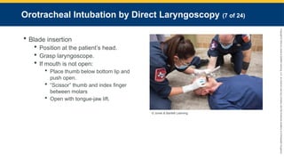 Copyright
©
2023
by
Jones
&
Bartlett
Learning,
LLC,
an
Ascend
Learning
Company
and
the
American
Academy
of
Orthopaedic
Surgeons.
Orotracheal Intubation by Direct Laryngoscopy (7 of 24)
 Blade insertion
 Position at the patient’s head.
 Grasp laryngoscope.
 If mouth is not open:
 Place thumb below bottom lip and
push open.
 “Scissor” thumb and index finger
between molars
 Open with tongue-jaw lift.
© Jones & Bartlett Learning.
 