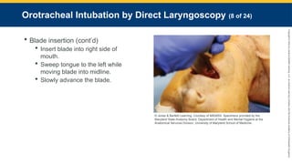 Copyright
©
2023
by
Jones
&
Bartlett
Learning,
LLC,
an
Ascend
Learning
Company
and
the
American
Academy
of
Orthopaedic
Surgeons.
Orotracheal Intubation by Direct Laryngoscopy (8 of 24)
 Blade insertion (cont’d)
 Insert blade into right side of
mouth.
 Sweep tongue to the left while
moving blade into midline.
 Slowly advance the blade.
© Jones & Bartlett Learning. Courtesy of MIEMSS. Specimens provided by the
Maryland State Anatomy Board, Department of Health and Mental Hygiene at the
Anatomical Services Division, University of Maryland School of Medicine.
 