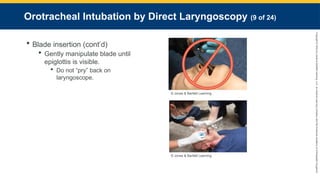 Copyright
©
2023
by
Jones
&
Bartlett
Learning,
LLC,
an
Ascend
Learning
Company
and
the
American
Academy
of
Orthopaedic
Surgeons.
Orotracheal Intubation by Direct Laryngoscopy (9 of 24)
 Blade insertion (cont’d)
 Gently manipulate blade until
epiglottis is visible.
 Do not “pry” back on
laryngoscope.
© Jones & Bartlett Learning.
© Jones & Bartlett Learning.
 