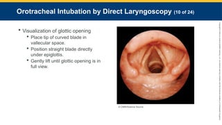Copyright
©
2023
by
Jones
&
Bartlett
Learning,
LLC,
an
Ascend
Learning
Company
and
the
American
Academy
of
Orthopaedic
Surgeons.
Orotracheal Intubation by Direct Laryngoscopy (10 of 24)
 Visualization of glottic opening
 Place tip of curved blade in
vallecular space.
 Position straight blade directly
under epiglottis.
 Gently lift until glottic opening is in
full view.
© CNRI/Science Source.
 