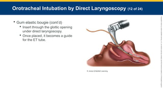 Copyright
©
2023
by
Jones
&
Bartlett
Learning,
LLC,
an
Ascend
Learning
Company
and
the
American
Academy
of
Orthopaedic
Surgeons.
Orotracheal Intubation by Direct Laryngoscopy (12 of 24)
 Gum elastic bougie (cont’d)
 Insert through the glottic opening
under direct laryngoscopy.
 Once placed, it becomes a guide
for the ET tube.
© Jones & Bartlett Learning.
 
