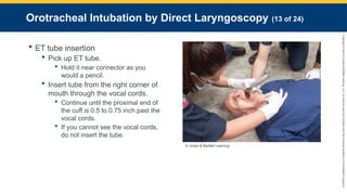 Copyright
©
2023
by
Jones
&
Bartlett
Learning,
LLC,
an
Ascend
Learning
Company
and
the
American
Academy
of
Orthopaedic
Surgeons.
Orotracheal Intubation by Direct Laryngoscopy (13 of 24)
 ET tube insertion
 Pick up ET tube.
 Hold it near connector as you
would a pencil.
 Insert tube from the right corner of
mouth through the vocal cords.
 Continue until the proximal end of
the cuff is 0.5 to 0.75 inch past the
vocal cords.
 If you cannot see the vocal cords,
do not insert the tube.
© Jones & Bartlett Learning.
 