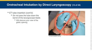 Copyright
©
2023
by
Jones
&
Bartlett
Learning,
LLC,
an
Ascend
Learning
Company
and
the
American
Academy
of
Orthopaedic
Surgeons.
Orotracheal Intubation by Direct Laryngoscopy (14 of 24)
 ET tube insertion (cont’d)
 Do not pass the tube down the
barrel of the laryngoscope blade.
 Will obscure your view of the
glottic opening
© Jones & Bartlett Learning.
 