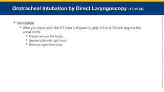 Copyright
©
2023
by
Jones
&
Bartlett
Learning,
LLC,
an
Ascend
Learning
Company
and
the
American
Academy
of
Orthopaedic
Surgeons.
Orotracheal Intubation by Direct Laryngoscopy (15 of 24)
 Ventilation
 After you have seen the ET tube cuff pass roughly 0.5 to 0.75 inch beyond the
vocal cords:
 Gently remove the blade.
 Secure tube with right hand.
 Remove stylet from tube.
 
