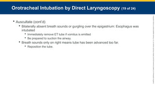Copyright
©
2023
by
Jones
&
Bartlett
Learning,
LLC,
an
Ascend
Learning
Company
and
the
American
Academy
of
Orthopaedic
Surgeons.
Orotracheal Intubation by Direct Laryngoscopy (19 of 24)
 Auscultate (cont’d)
 Bilaterally absent breath sounds or gurgling over the epigastrium: Esophagus was
intubated
 Immediately remove ET tube if vomitus is emitted
 Be prepared to suction the airway.
 Breath sounds only on right means tube has been advanced too far.
 Reposition the tube.
 