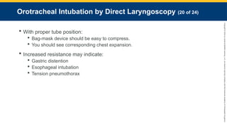 Copyright
©
2023
by
Jones
&
Bartlett
Learning,
LLC,
an
Ascend
Learning
Company
and
the
American
Academy
of
Orthopaedic
Surgeons.
Orotracheal Intubation by Direct Laryngoscopy (20 of 24)
 With proper tube position:
 Bag-mask device should be easy to compress.
 You should see corresponding chest expansion.
 Increased resistance may indicate:
 Gastric distention
 Esophageal intubation
 Tension pneumothorax
 