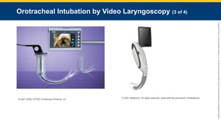 Copyright
©
2023
by
Jones
&
Bartlett
Learning,
LLC,
an
Ascend
Learning
Company
and
the
American
Academy
of
Orthopaedic
Surgeons.
Orotracheal Intubation by Video Laryngoscopy (3 of 4)
© 2021 KARL STORZ Endoscopy-America, Inc.
© 2021 Medtronic. All rights reserved. Used with the permission of Medtronic.
 