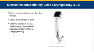 Copyright
©
2023
by
Jones
&
Bartlett
Learning,
LLC,
an
Ascend
Learning
Company
and
the
American
Academy
of
Orthopaedic
Surgeons.
Orotracheal Intubation by Video Laryngoscopy (4 of 4)
 Some require displacement of the
tongue.
 Some are inserted midline.
 Refer to Skill Drill 16-10:
Performing Orotracheal
Intubation Using Video
Laryngoscopy
Used with permission from Ambu A/S.
 