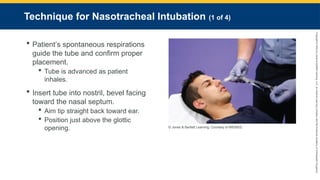 Copyright
©
2023
by
Jones
&
Bartlett
Learning,
LLC,
an
Ascend
Learning
Company
and
the
American
Academy
of
Orthopaedic
Surgeons.
Technique for Nasotracheal Intubation (1 of 4)
 Patient’s spontaneous respirations
guide the tube and confirm proper
placement.
 Tube is advanced as patient
inhales.
 Insert tube into nostril, bevel facing
toward the nasal septum.
 Aim tip straight back toward ear.
 Position just above the glottic
opening. © Jones & Bartlett Learning. Courtesy of MIEMSS.
 