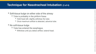 Copyright
©
2023
by
Jones
&
Bartlett
Learning,
LLC,
an
Ascend
Learning
Company
and
the
American
Academy
of
Orthopaedic
Surgeons.
Technique for Nasotracheal Intubation (3 of 4)
 Soft-tissue bulge on either side of the airway
 Tube is probably in the piriform fossa
 Hold head still, slightly withdraw the tube.
 Once maximum airflow is detected, advance tube.
 No soft-tissue bulge
 Tube has entered the esophagus.
 Withdraw until you detect airflow; extend head.
 
