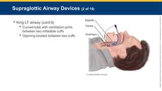 Copyright
©
2023
by
Jones
&
Bartlett
Learning,
LLC,
an
Ascend
Learning
Company
and
the
American
Academy
of
Orthopaedic
Surgeons.
Supraglottic Airway Devices (2 of 19)
 King LT airway (cont’d)
 Curved tube with ventilation ports
between two inflatable cuffs
 Opening located between two cuffs
© Jones & Bartlett Learning.
 