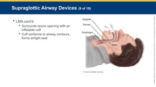 Copyright
©
2023
by
Jones
&
Bartlett
Learning,
LLC,
an
Ascend
Learning
Company
and
the
American
Academy
of
Orthopaedic
Surgeons.
Supraglottic Airway Devices (9 of 19)
 LMA cont’d
 Surrounds larynx opening with an
inflatable cuff
 Cuff conforms to airway contours,
forms airtight seal
© Jones & Bartlett Learning.
 