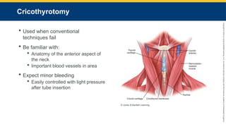 Copyright
©
2023
by
Jones
&
Bartlett
Learning,
LLC,
an
Ascend
Learning
Company
and
the
American
Academy
of
Orthopaedic
Surgeons.
Cricothyrotomy
 Used when conventional
techniques fail
 Be familiar with:
 Anatomy of the anterior aspect of
the neck
 Important blood vessels in area
 Expect minor bleeding
 Easily controlled with light pressure
after tube insertion
© Jones & Bartlett Learning.
 