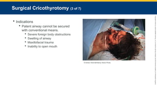 Copyright
©
2023
by
Jones
&
Bartlett
Learning,
LLC,
an
Ascend
Learning
Company
and
the
American
Academy
of
Orthopaedic
Surgeons.
Surgical Cricothyrotomy (3 of 7)
 Indications
 Patent airway cannot be secured
with conventional means.
 Severe foreign body obstructions
 Swelling of airway
 Maxillofacial trauma
 Inability to open mouth
© Adrian Sherratt/Alamy Stock Photo.
 