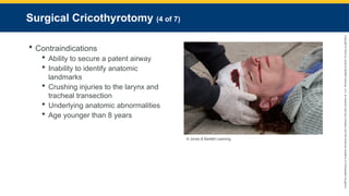 Copyright
©
2023
by
Jones
&
Bartlett
Learning,
LLC,
an
Ascend
Learning
Company
and
the
American
Academy
of
Orthopaedic
Surgeons.
Surgical Cricothyrotomy (4 of 7)
 Contraindications
 Ability to secure a patent airway
 Inability to identify anatomic
landmarks
 Crushing injuries to the larynx and
tracheal transection
 Underlying anatomic abnormalities
 Age younger than 8 years
© Jones & Bartlett Learning.
 