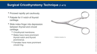 Copyright
©
2023
by
Jones
&
Bartlett
Learning,
LLC,
an
Ascend
Learning
Company
and
the
American
Academy
of
Orthopaedic
Surgeons.
Surgical Cricothyrotomy Technique (1 of 3)
 Proceed rapidly yet cautiously.
 Palpate for V notch of thyroid
cartilage.
 Slide index finger into depression
between thyroid and cricoid
cartilage.
 Cricothyroid membrane
 Males have more prominent
thyroid notch and thyroid
prominence.
 Females have more prominent
cricoid ring.
© Medline Industries, Inc.
 
