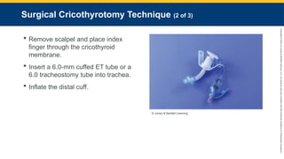 Copyright
©
2023
by
Jones
&
Bartlett
Learning,
LLC,
an
Ascend
Learning
Company
and
the
American
Academy
of
Orthopaedic
Surgeons.
Surgical Cricothyrotomy Technique (2 of 3)
 Remove scalpel and place index
finger through the cricothyroid
membrane.
 Insert a 6.0-mm cuffed ET tube or a
6.0 tracheostomy tube into trachea.
 Inflate the distal cuff.
© Jones & Bartlett Learning.
 