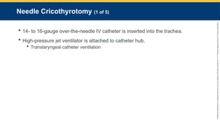 Copyright
©
2023
by
Jones
&
Bartlett
Learning,
LLC,
an
Ascend
Learning
Company
and
the
American
Academy
of
Orthopaedic
Surgeons.
Needle Cricothyrotomy (1 of 5)
 14- to 16-gauge over-the-needle IV catheter is inserted into the trachea.
 High-pressure jet ventilator is attached to catheter hub.
 Translaryngeal catheter ventilation
 
