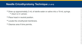 Copyright
©
2023
by
Jones
&
Bartlett
Learning,
LLC,
an
Ascend
Learning
Company
and
the
American
Academy
of
Orthopaedic
Surgeons.
Needle Cricothyrotomy Technique (1 of 4)
 Draw up approximately 3 mL of sterile water or saline into a 10-mL syringe.
 Attach to IV catheter.
 Place head in neutral position.
 Locate the cricothyroid membrane.
 Cleanse area if time permits.
 