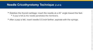 Copyright
©
2023
by
Jones
&
Bartlett
Learning,
LLC,
an
Ascend
Learning
Company
and
the
American
Academy
of
Orthopaedic
Surgeons.
Needle Cricothyrotomy Technique (2 of 4)
 Stabilize the thyroid cartilage; insert the needle at a 45° angle toward the feet.
 A pop is felt as the needle penetrates the membrane.
 After a pop is felt, insert needle 0.5 inch farther; aspirate with the syringe.
 