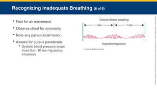 Copyright
©
2023
by
Jones
&
Bartlett
Learning,
LLC,
an
Ascend
Learning
Company
and
the
American
Academy
of
Orthopaedic
Surgeons.
Recognizing Inadequate Breathing (6 of 8)
 Feel for air movement.
 Observe chest for symmetry.
 Note any paradoxical motion.
 Assess for pulsus paradoxus.
 Systolic blood pressure drops
more than 10 mm Hg during
inhalation.
© Jones & Bartlett Learning.
 