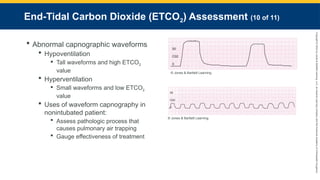 Copyright
©
2023
by
Jones
&
Bartlett
Learning,
LLC,
an
Ascend
Learning
Company
and
the
American
Academy
of
Orthopaedic
Surgeons.
End-Tidal Carbon Dioxide (ETCO2) Assessment (10 of 11)
 Abnormal capnographic waveforms
 Hypoventilation
 Tall waveforms and high ETCO2
value
 Hyperventilation
 Small waveforms and low ETCO2
value
 Uses of waveform capnography in
nonintubated patient:
 Assess pathologic process that
causes pulmonary air trapping
 Gauge effectiveness of treatment
© Jones & Bartlett Learning.
© Jones & Bartlett Learning.
 