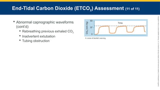 Copyright
©
2023
by
Jones
&
Bartlett
Learning,
LLC,
an
Ascend
Learning
Company
and
the
American
Academy
of
Orthopaedic
Surgeons.
End-Tidal Carbon Dioxide (ETCO2) Assessment (11 of 11)
 Abnormal capnographic waveforms
(cont’d)
 Rebreathing previous exhaled CO2
 Inadvertent extubation
 Tubing obstruction
© Jones & Bartlett Learning.
 