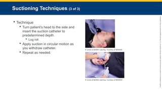 Copyright
©
2023
by
Jones
&
Bartlett
Learning,
LLC,
an
Ascend
Learning
Company
and
the
American
Academy
of
Orthopaedic
Surgeons.
Suctioning Techniques (3 of 3)
 Technique
 Turn patient’s head to the side and
insert the suction catheter to
predetermined depth.
 Log roll
 Apply suction in circular motion as
you withdraw catheter.
 Repeat as needed.
© Jones & Bartlett Learning. Courtesy of MIEMSS
© Jones & Bartlett Learning. Courtesy of MIEMSS
 