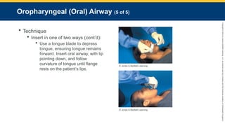 Copyright
©
2023
by
Jones
&
Bartlett
Learning,
LLC,
an
Ascend
Learning
Company
and
the
American
Academy
of
Orthopaedic
Surgeons.
Oropharyngeal (Oral) Airway (5 of 5)
 Technique
 Insert in one of two ways (cont’d):
 Use a tongue blade to depress
tongue, ensuring tongue remains
forward. Insert oral airway, with tip
pointing down, and follow
curvature of tongue until flange
rests on the patient’s lips.
© Jones & Bartlett Learning.
© Jones & Bartlett Learning.
 