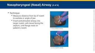 Copyright
©
2023
by
Jones
&
Bartlett
Learning,
LLC,
an
Ascend
Learning
Company
and
the
American
Academy
of
Orthopaedic
Surgeons.
Nasopharyngeal (Nasal) Airway (4 of 4)
 Technique
 Measure distance from tip of nostril
to earlobe or angle of jaw.
 Insert prelubricated airway into
larger nostril, with bevel facing the
septum, until flange rests on
patient’s nostril. © Jones & Bartlett Learning.
© Jones & Bartlett Learning.
 