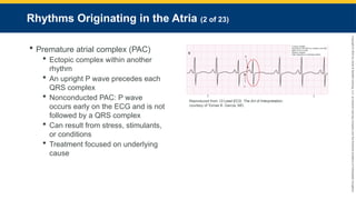 Copyright
©
2023
by
Jones
&
Bartlett
Learning,
LLC,
an
Ascend
Learning
Company
and
the
American
Academy
of
Orthopaedic
Surgeons.
Rhythms Originating in the Atria (2 of 23)
 Premature atrial complex (PAC)
 Ectopic complex within another
rhythm
 An upright P wave precedes each
QRS complex
 Nonconducted PAC: P wave
occurs early on the ECG and is not
followed by a QRS complex
 Can result from stress, stimulants,
or conditions
 Treatment focused on underlying
cause
Reproduced from 12-Lead ECG: The Art of Interpretation,
courtesy of Tomas B. Garcia, MD.
 