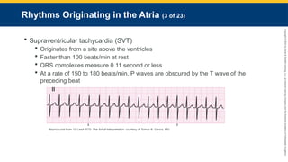 Copyright
©
2023
by
Jones
&
Bartlett
Learning,
LLC,
an
Ascend
Learning
Company
and
the
American
Academy
of
Orthopaedic
Surgeons.
Rhythms Originating in the Atria (3 of 23)
 Supraventricular tachycardia (SVT)
 Originates from a site above the ventricles
 Faster than 100 beats/min at rest
 QRS complexes measure 0.11 second or less
 At a rate of 150 to 180 beats/min, P waves are obscured by the T wave of the
preceding beat
Reproduced from 12-Lead ECG: The Art of Interpretation, courtesy of Tomas B. Garcia, MD.
 